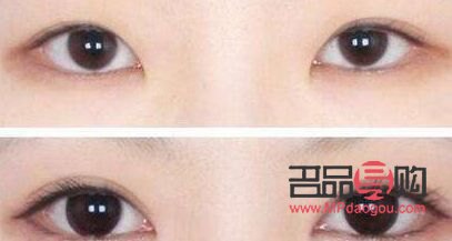 <h3>雙眼皮納米無(wú)痕與全切，哪種更優(yōu)？</h3>