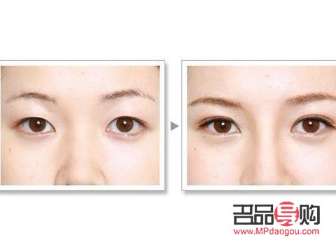 雙眼皮納米無(wú)痕與全切，哪種更優(yōu)？