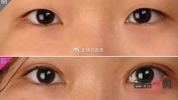 <h3>翹睫術(shù)雙眼皮能保持多久恢復(fù)</h3>