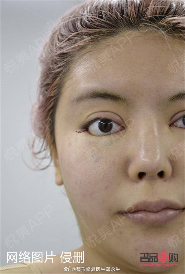 怎樣把內(nèi)雙眼皮變成外雙眼皮