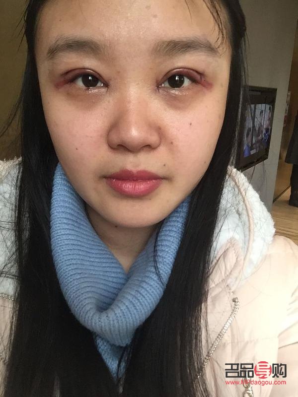 割雙眼皮成內(nèi)雙誰的責(zé)任(割雙眼皮成內(nèi)雙能讓醫(yī)院修復(fù)嗎)