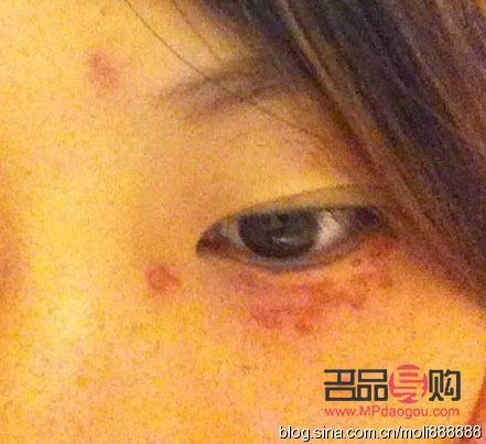 眼部汗管瘤圖片(眼部汗管瘤圖片是怎么形成的)