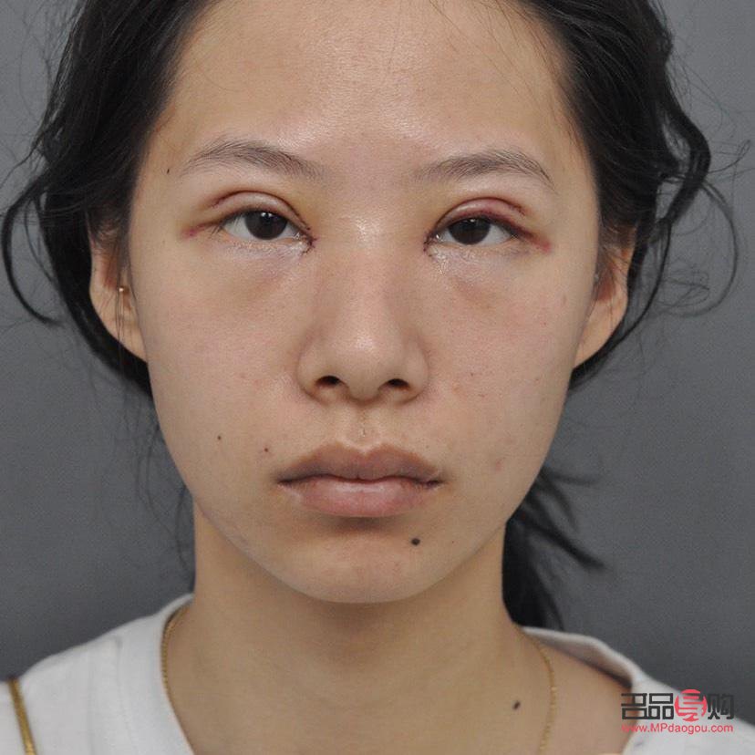 雙眼皮手術(shù)哪家強(qiáng)？專業(yè)醫(yī)院助你實(shí)現(xiàn)電眼魅力