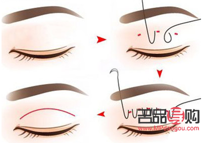 眼睛埋線多久會(huì)消失(眼睛埋線多久會(huì)消失掉)