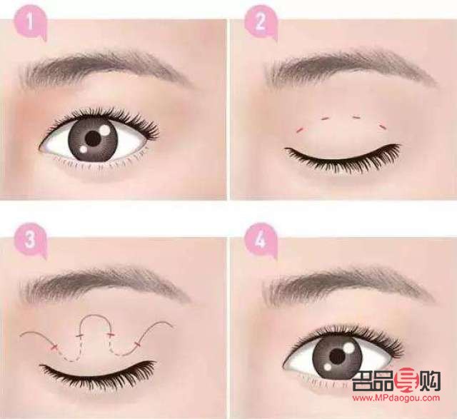 眼睛埋線多久會消失(眼睛埋線多久會消失掉)