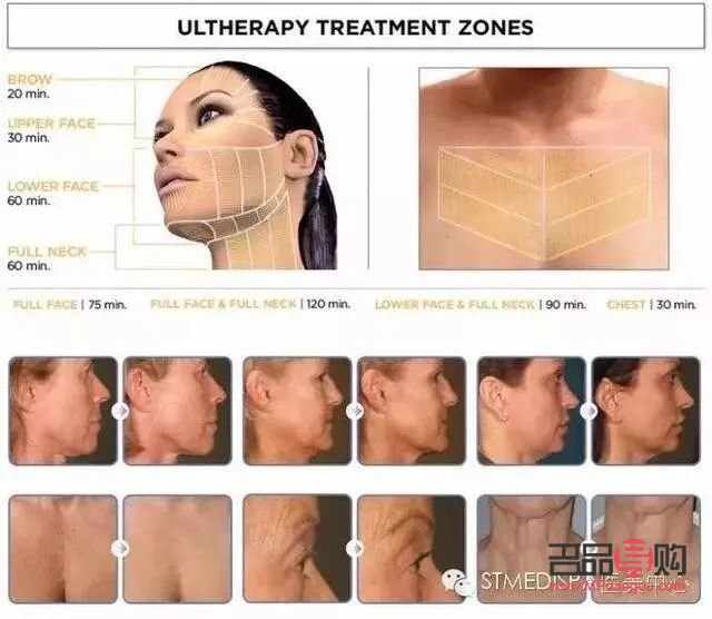 <h3>美容超聲刀：肌膚緊致新選擇，效果與注意事項(xiàng)全解析</h3>