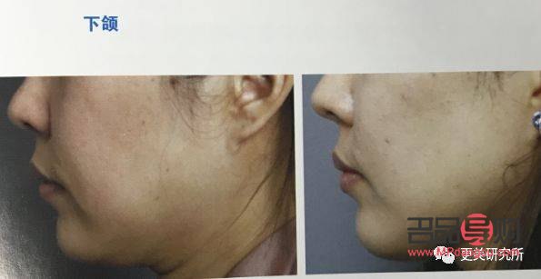 <h3>美容超聲刀：肌膚緊致新選擇，效果與注意事項(xiàng)全解析</h3>