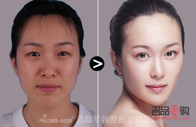 小眼睛開(kāi)眼角雙眼皮效果圖大全(小眼睛開(kāi)眼角雙眼皮效果圖大全圖片)