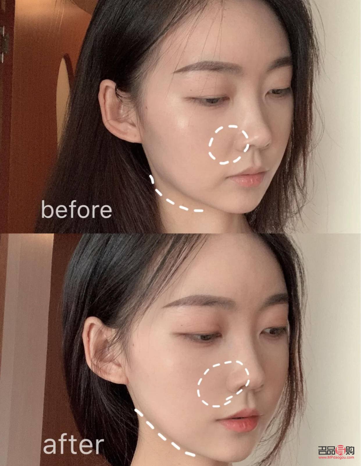 眼部熱瑪吉危害(眼部熱瑪吉副作用)