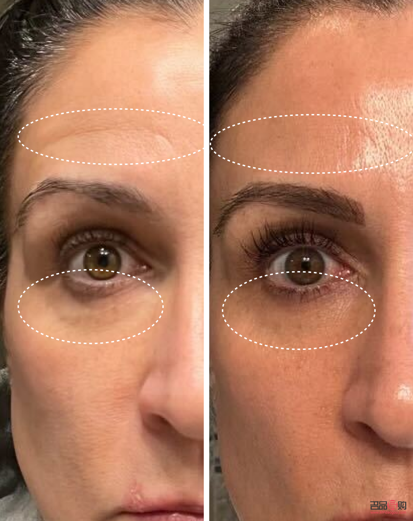 <h3>眼皮下垂缺什么營養(yǎng)</h3>