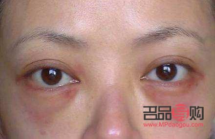 怎樣消除眼袋水腫最有效的方法(怎樣消除眼袋水腫最有效的方法視頻)