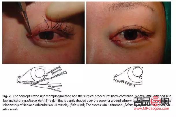 外眼角需要開嗎(外眼角可以開到什么程度)