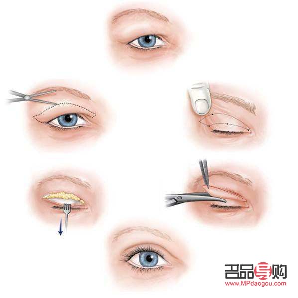 <h3>四十多歲做雙眼皮，煥發(fā)新光彩</h3>