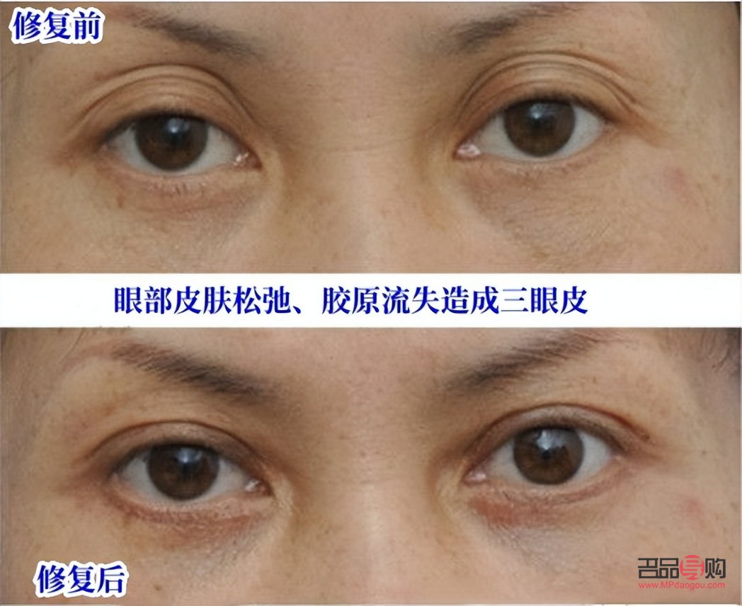 上眼皮腫怎么按摩消腫(上眼皮腫怎么按摩消腫快)