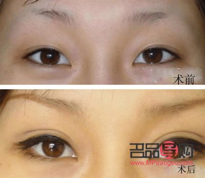 雙眼皮割窄了可以加寬嗎(雙平面提升術(shù)全臉價(jià)格)
