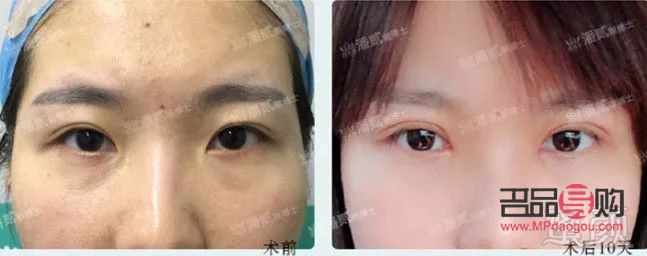 雙眼皮割窄了可以加寬嗎(雙平面提升術(shù)全臉價(jià)格)