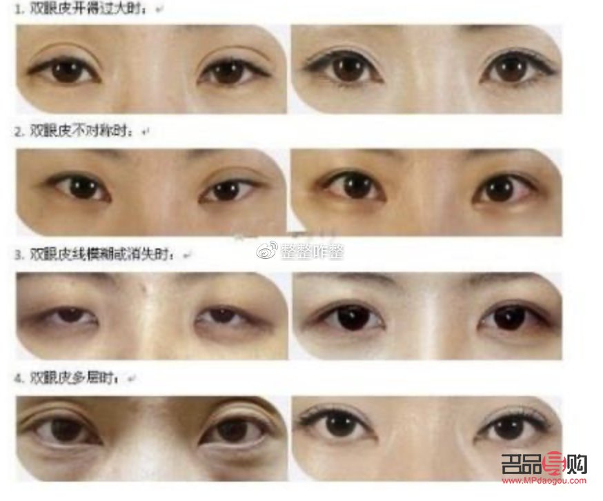 雙眼皮割窄了可以加寬嗎(雙平面提升術(shù)全臉價(jià)格)