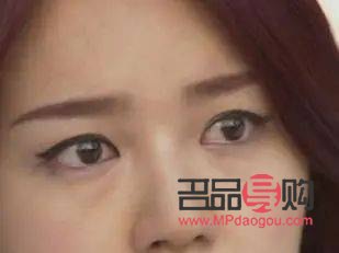 <h3>大小眼適合做哪種雙眼皮</h3>