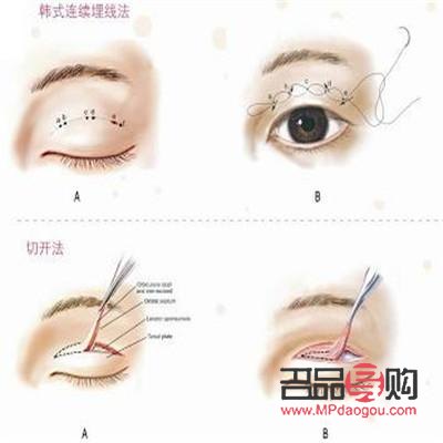 大小眼適合做哪種雙眼皮