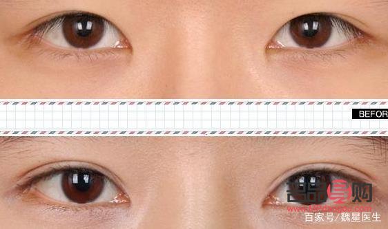 怎樣可以把內雙眼皮變成外雙(怎樣可以把內雙眼皮變成外雙眼皮)