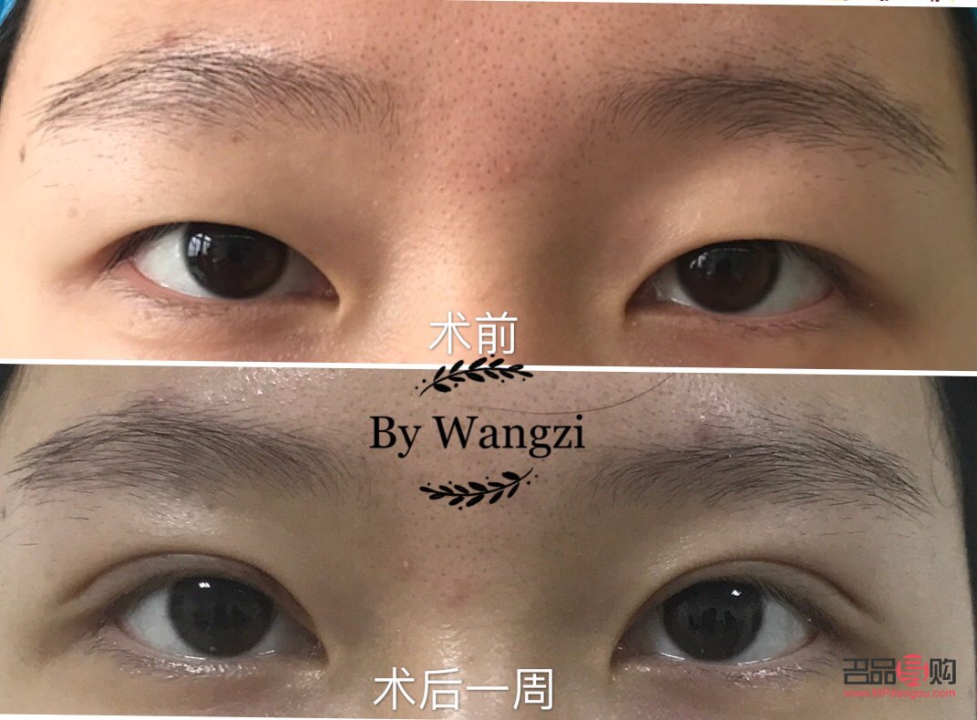 眼部抽脂前后對(duì)比照片(眼部抽脂前后對(duì)比照片側(cè)面)