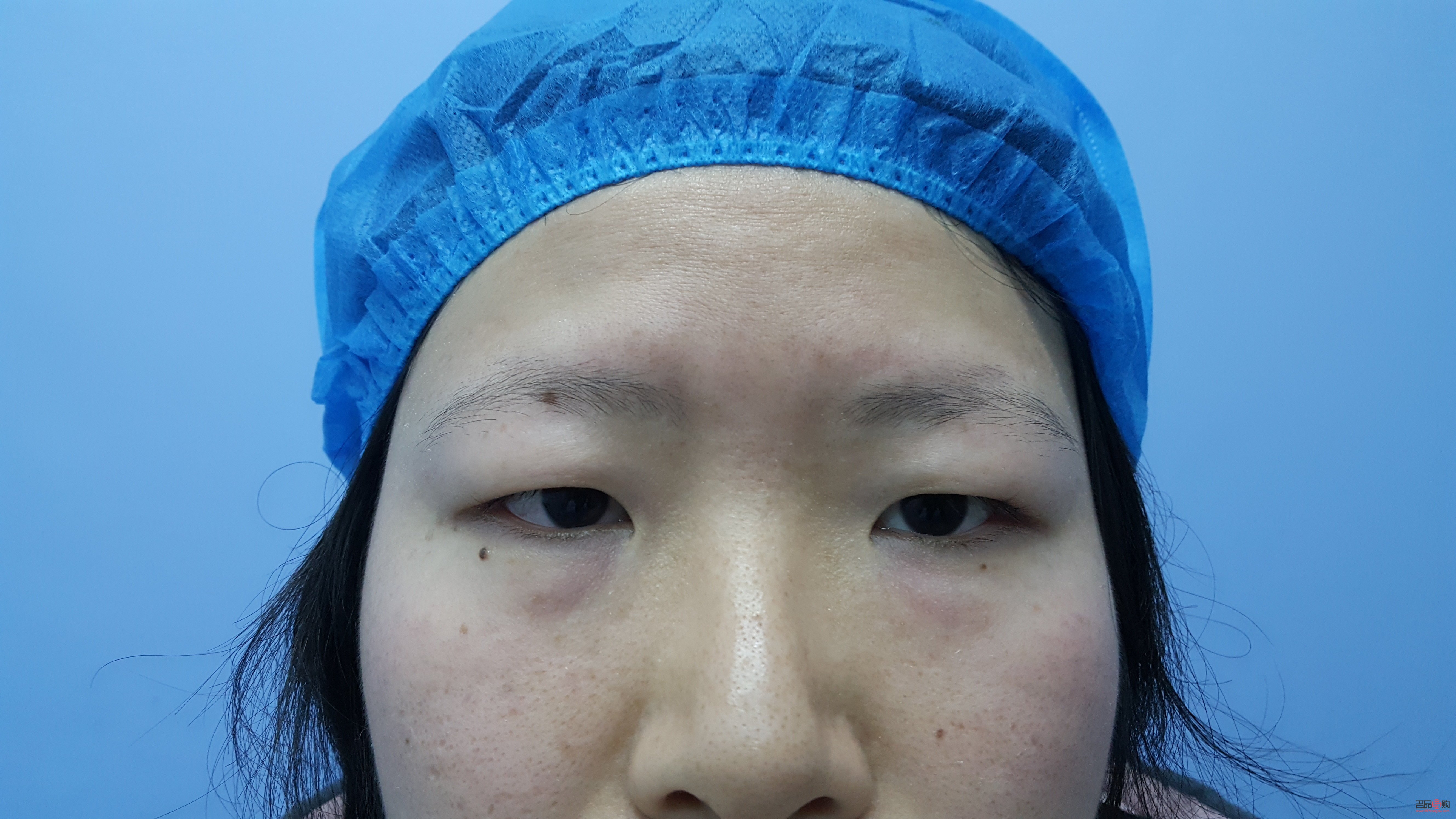 腫眼泡適合做雙眼皮嗎(腫眼泡適合做什么樣的雙眼皮)