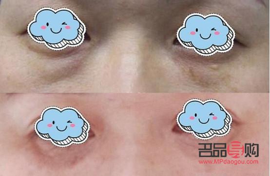 <h3>眼袋手術(shù)失敗案例分析與警示</h3>