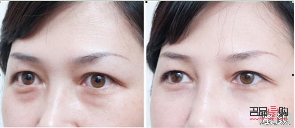 眼袋手術(shù)失敗案例分析與警示