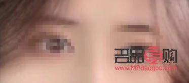 填充眼窩凹陷脂肪存活率高嗎(填充眼窩凹陷脂肪存活率高嗎?)