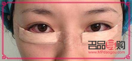 微創(chuàng)眼袋手術(shù)視頻(微創(chuàng)眼袋手術(shù)視頻全過(guò)程)