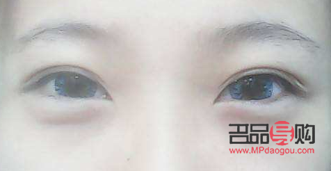 微創(chuàng)眼袋手術(shù)視頻(微創(chuàng)眼袋手術(shù)視頻全過(guò)程)