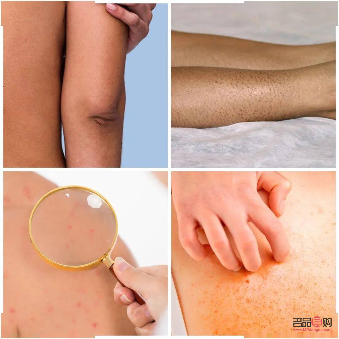 身體火燒怎么護理(身體火燒怎么護理最好)