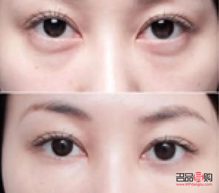 <h3>眼袋與臥蠶的區(qū)別圖片對(duì)比：了解差異，打造美麗眼部</h3>