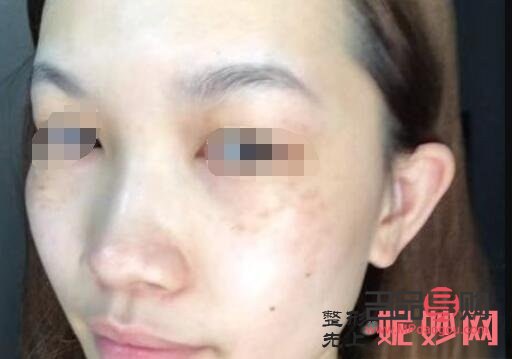 <h3>美容祛斑要多少錢？全面解析祛斑費用及影響因素</h3>