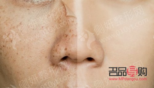 美容祛斑要多少錢？全面解析祛斑費(fèi)用及影響因素