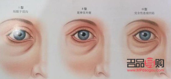 去眼袋的注意事項(xiàng)和飲食(去眼袋的注意事項(xiàng)和飲食注意事項(xiàng))