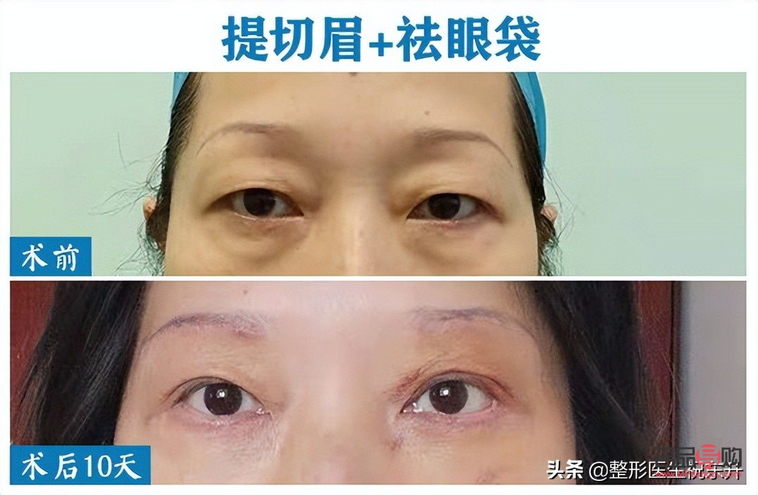 切雙眼皮和提眉哪種效果好(切雙眼皮和提眉哪種效果好些)