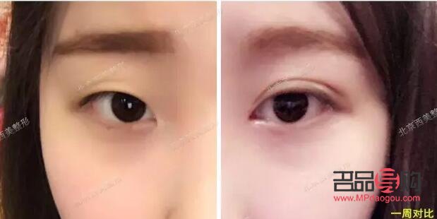 開扇6mm雙眼皮圖片(開扇6mm雙眼皮圖片真實(shí))