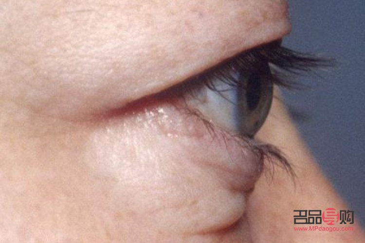 眼凸的圖片(眼凸的圖片大全)