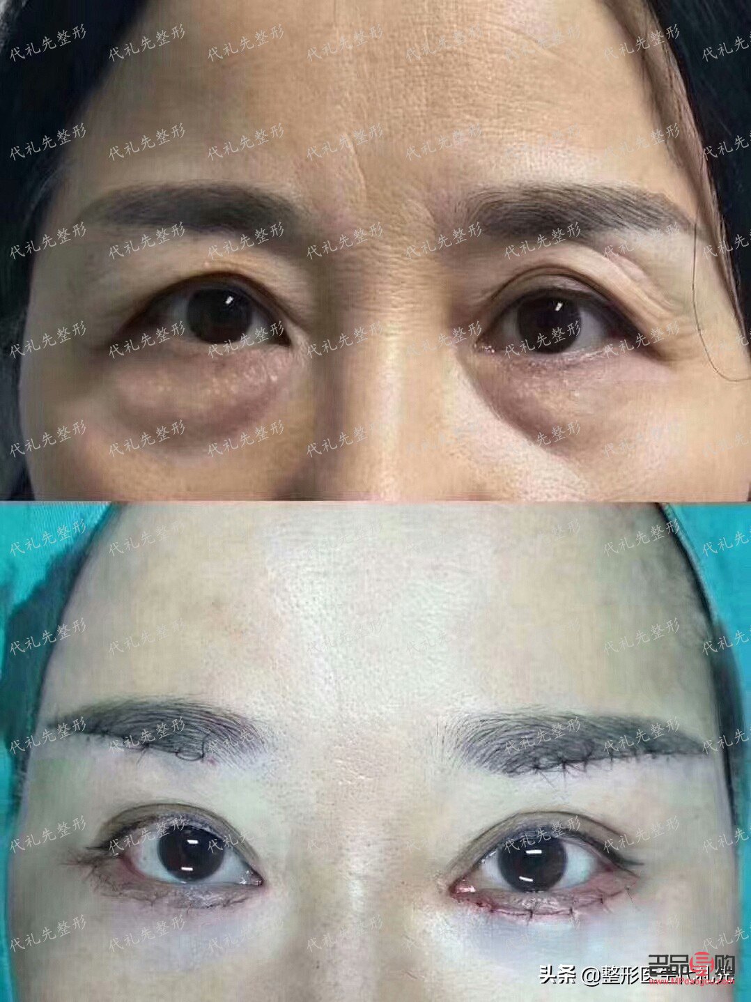 怎么消除眼袋最有效的辦法(怎么消除眼袋最有效的辦法松弛)