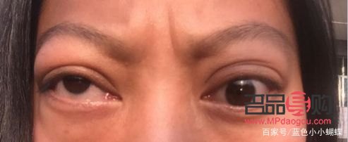 甲亢引起眼睛一大一小怎么辦(甲亢引起眼睛一大一小怎么辦呢)