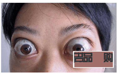 甲亢引起眼睛一大一小怎么辦(甲亢引起眼睛一大一小怎么辦呢)