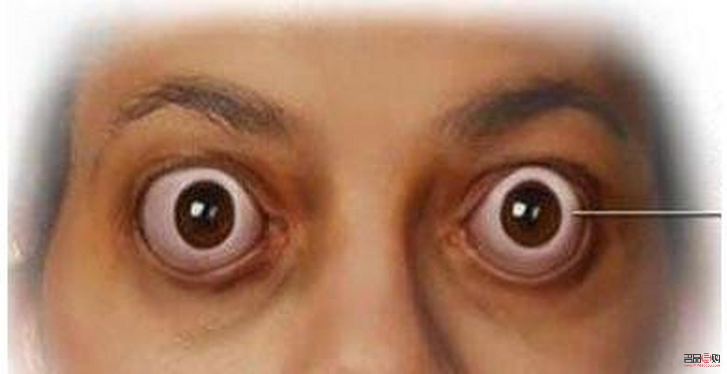 甲亢引起眼睛一大一小怎么辦(甲亢引起眼睛一大一小怎么辦呢)