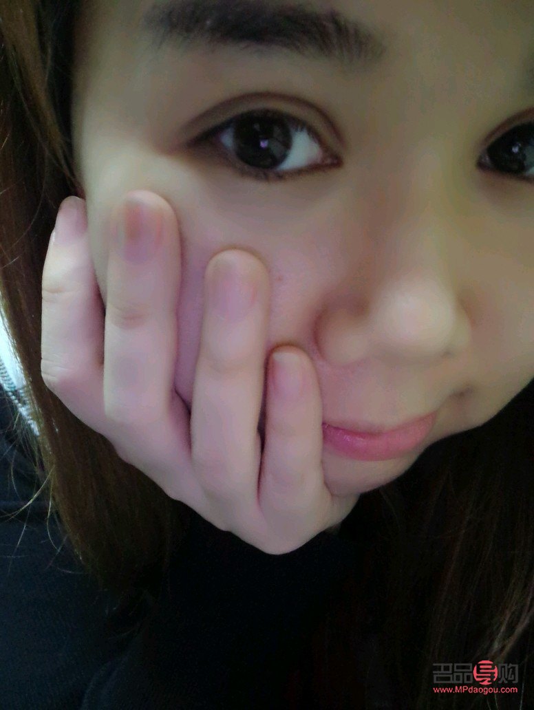 <h3>埋線雙眼皮兩次，打造迷人電眼</h3>