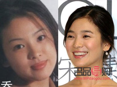 <h3>平行雙眼皮圖片前后對比圖大揭秘，打造迷人電眼新境界！</h3>