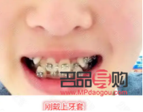 眼睛一大一小矯正費用多少(眼睛一大一小矯正要多少錢)