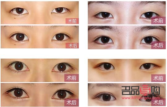 眼睛一大一小矯正費用多少(眼睛一大一小矯正要多少錢)