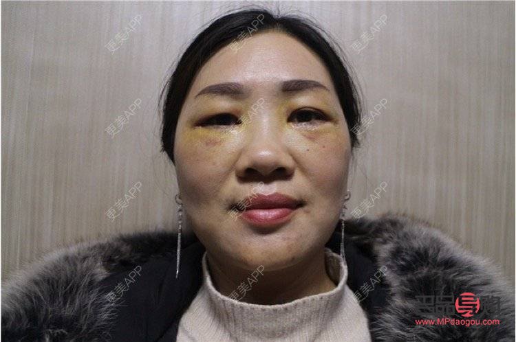 去除眼袋手術(shù)價(jià)格(去除眼袋手術(shù)價(jià)格表 常州美貝爾電話多少)