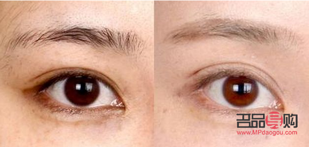 內(nèi)雙怎么才能變成雙眼皮(內(nèi)雙怎么才能變成雙眼皮小技巧)