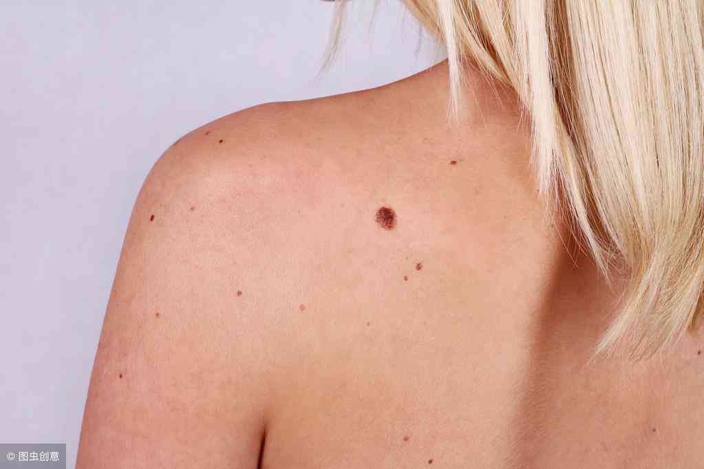 怎么遮痣不用化妝品處理(怎么遮痣不用化妝品處理掉)